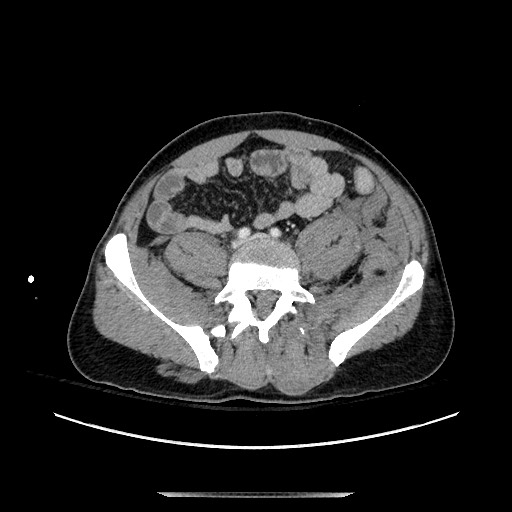 Blunt abdominal trauma with solid organ and musculoskelatal injury with active extravasation (Radiopaedia 68364-77895 A 108).jpg