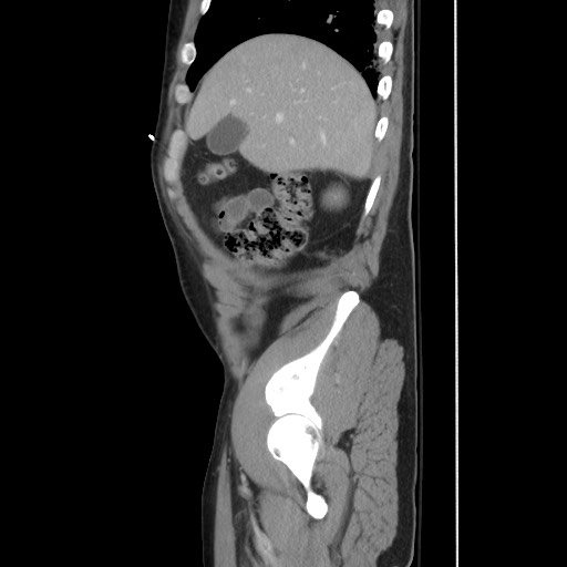 File:Blunt abdominal trauma with solid organ and musculoskelatal injury with active extravasation (Radiopaedia 68364-77895 C 39).jpg