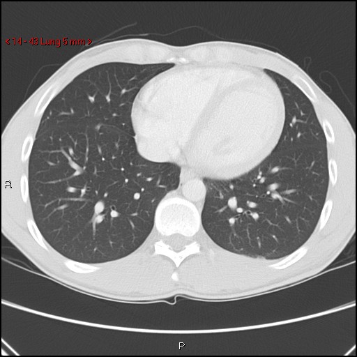 Blunt chest trauma - pulmonary interstitial emphysema and pneumomediastinum (Radiopaedia 20666-20552 Axial lung window 43).jpg