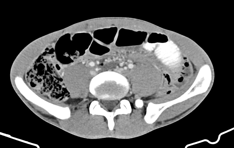Blunt injury to the small bowel (Radiopaedia 74953-85987 A 125).jpg