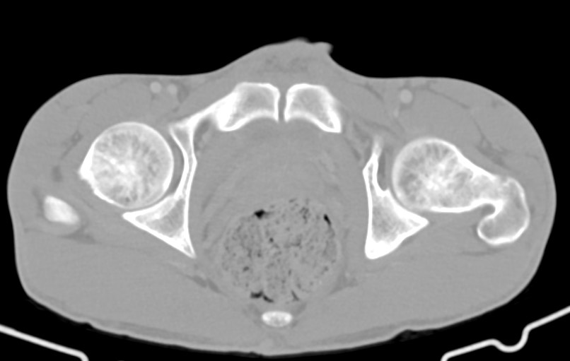 Blunt injury to the small bowel (Radiopaedia 74953-85987 Axial Wide 95).jpg