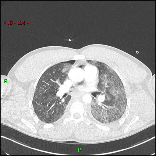 Blunt thoracic trauma (Radiopaedia 73454-84221 Axial lung window 46).jpg
