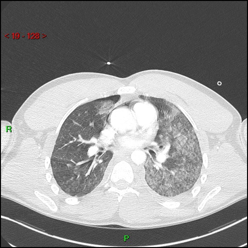 Blunt thoracic trauma (Radiopaedia 73454-84221 Axial lung window 47).jpg