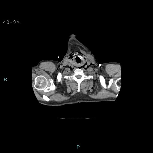 Boerhaave syndrome (Radiopaedia 27683-27897 Axial non-contrast 3).jpg