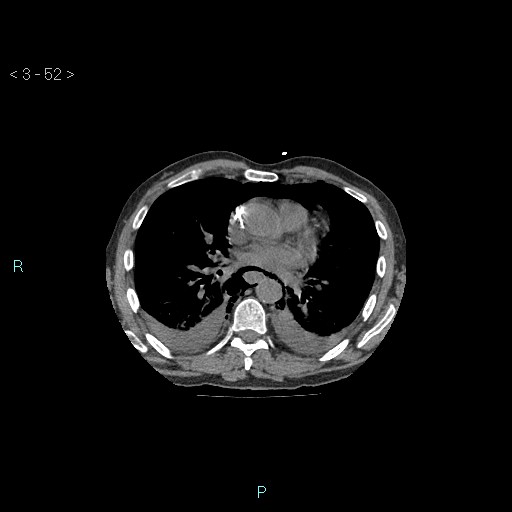 Boerhaave syndrome (Radiopaedia 27683-27897 Axial non-contrast 52).jpg