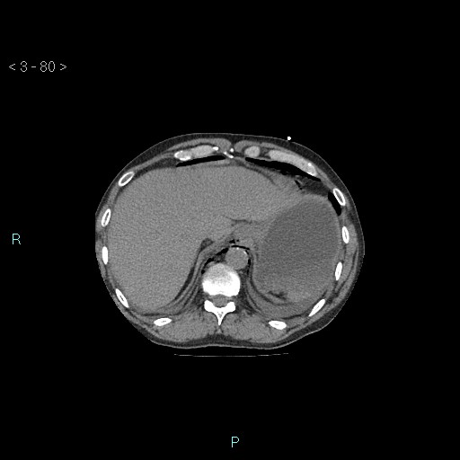Boerhaave syndrome (Radiopaedia 27683-27897 Axial non-contrast 80).jpg