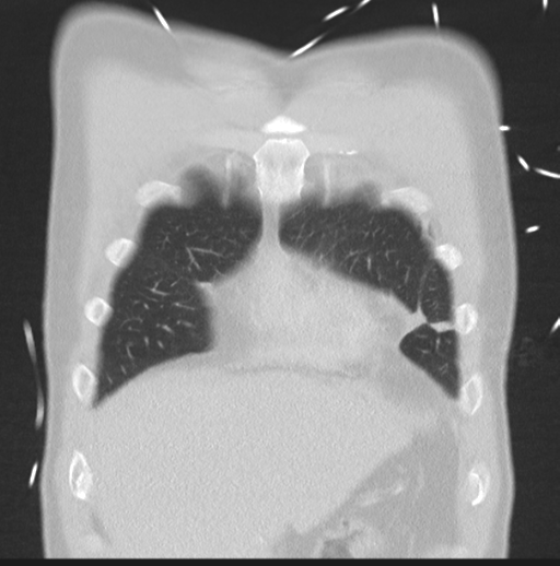 Boerhaave syndrome (Radiopaedia 39382-41661 Coronal lung window 9).png