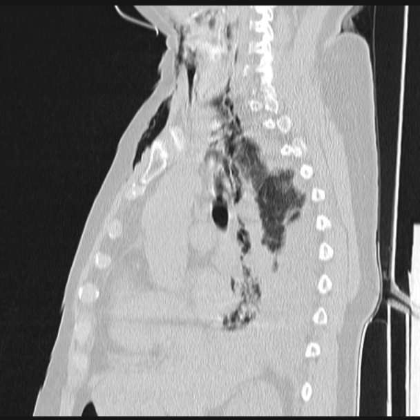 Boerhaave syndrome (Radiopaedia 45644-49799 Sagittal lung window 34).jpg
