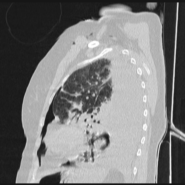 Boerhaave syndrome (Radiopaedia 45644-49799 Sagittal lung window 62).jpg