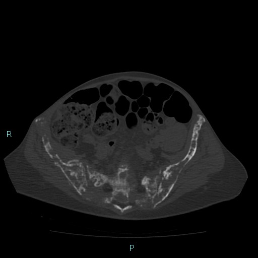 File:Bone metastases from untreated breast cancer (Radiopaedia 42973-46219 Axial bone window 155).jpg