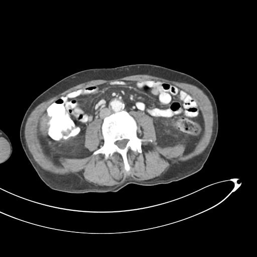 Bone metastasis from squamous cell carcinoma (Radiopaedia 30133-30730 B 41).jpg