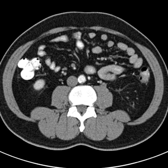 File:Bosniak cyst - type IV (Radiopaedia 23525-23627 renal cortical phase 45).jpg
