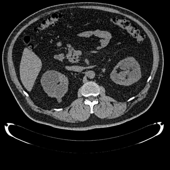 Bosniak renal cyst - type IV (Radiopaedia 24244-24518 Axial non-contrast 138).jpg