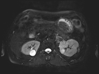 File:Bouveret syndrome (Radiopaedia 61017-68856 Axial MRCP 27).jpg