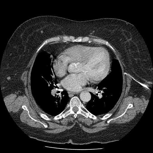Bovine aortic arch - right internal mammary vein drains into the superior vena cava (Radiopaedia 63296-71875 A 86).jpg