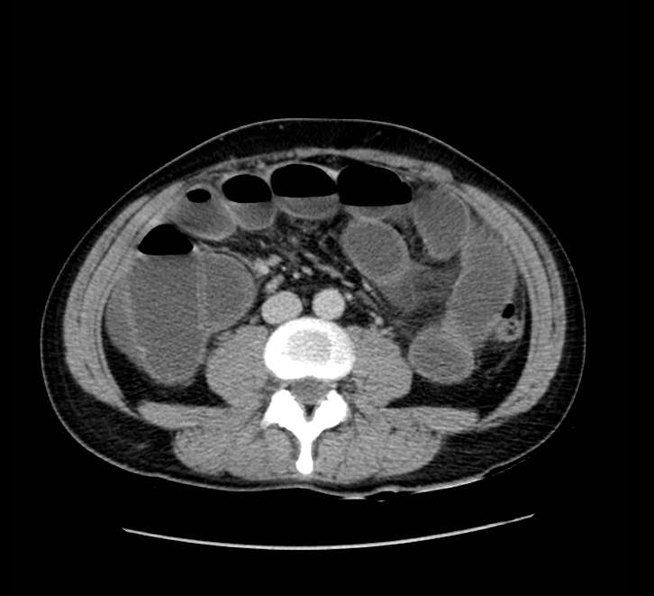 Bowel obstruction from colon carcinoma (Radiopaedia 22995-23028 A 47).jpg
