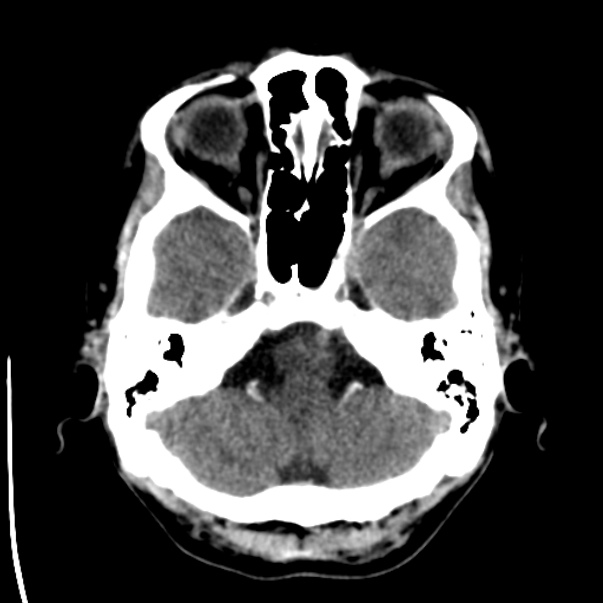 Brain metastases from lung cancer (Radiopaedia 24480-24781 Axial non-contrast 7).jpg