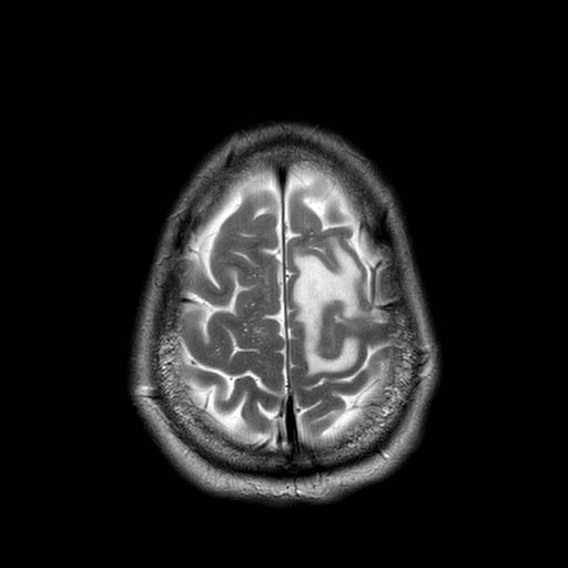 File:Brain metastases from lung cancer (Radiopaedia 83839-99028 Axial T2 31).jpg