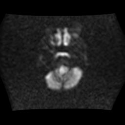 File:Brainstem glioma (Radiopaedia 30923-31624 Axial DWI 3).jpg