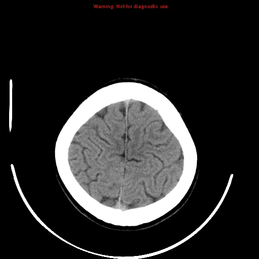 File:Brainstem glioma (Radiopaedia 9444-10123 non-contrast 22).jpg