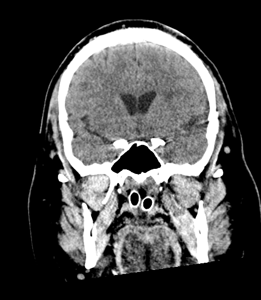 File:Brainstem hemorrhage (Radiopaedia 81294-94976 Coronal non-contrast 26).jpg