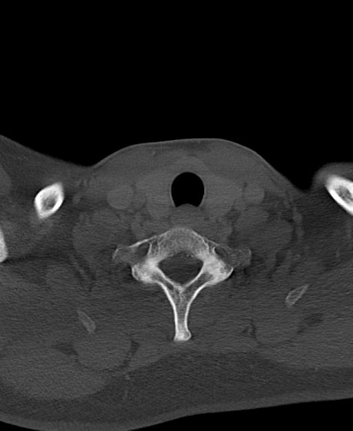 Branchial cleft cyst (Radiopaedia 31167-31875 Axial bone window 60).jpg