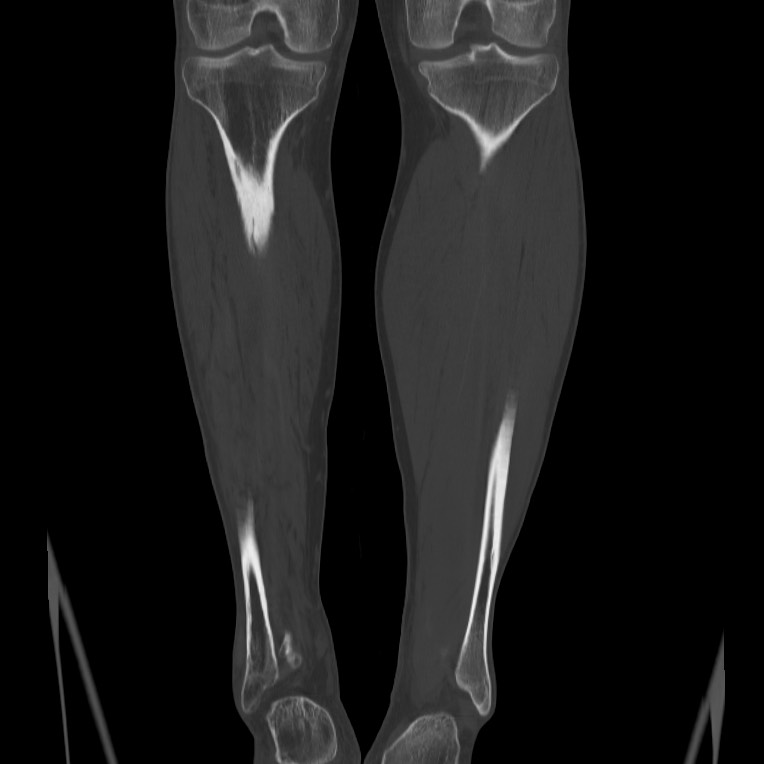 Brodie abscess - tibia (Radiopaedia 66028-75204 Coronal bone window 47).jpg