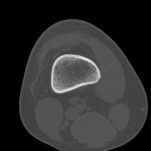 Brodie abscess of the tibia (Radiopaedia 58984-66250 Axial bone window 8).jpg