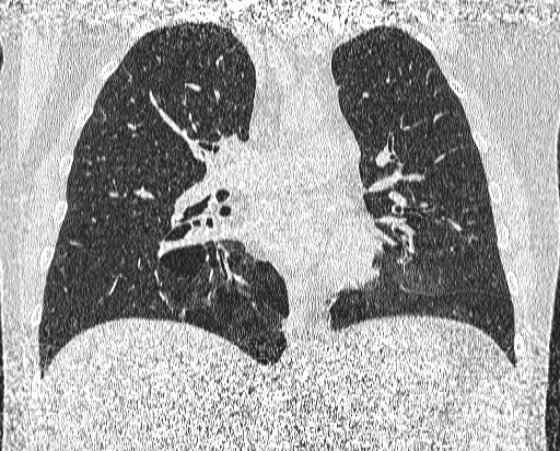 Bronchial atresia (Radiopaedia 58271-65417 Coronal lung window 27).jpg