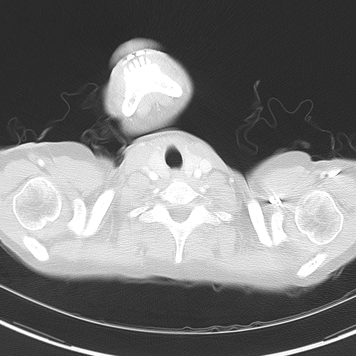 Bronchial atresia (Radiopaedia 73677-84470 Axial lung window 4).jpg