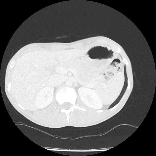 Bronchial carcinoid tumor causing right lower lobe collapse (Radiopaedia 83495-98594 Axial lung window 57).jpg