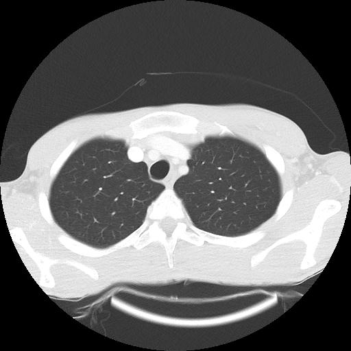 Bronchial carcinoid tumor causing right lower lobe collapse (Radiopaedia 83495-98594 Axial lung window 7).jpg