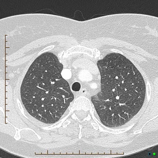 Bronchial diverticula (Radiopaedia 79512-92676 Axial lung window 39).jpg