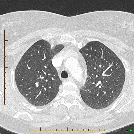 Bronchial diverticula (Radiopaedia 79512-92676 Axial lung window 46).jpg