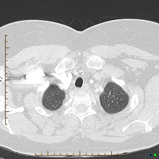 File:Bronchial diverticula (Radiopaedia 79512-92676 Axial lung window 9).jpg