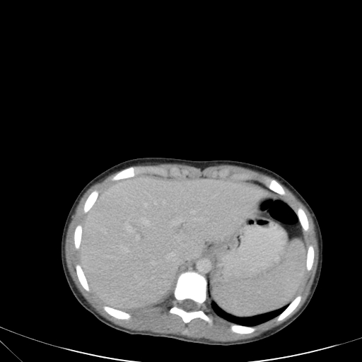 Bronchial mucoepidermoid carcinoma (Radiopaedia 57023-63895 Axial 94).jpg