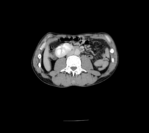 Bronchiectasis in Crohn disease (Radiopaedia 60311-67977 B 87).jpg