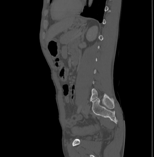 File:Bronchiectasis in Crohn disease (Radiopaedia 60311-67977 Sagittal bone window 167).jpg