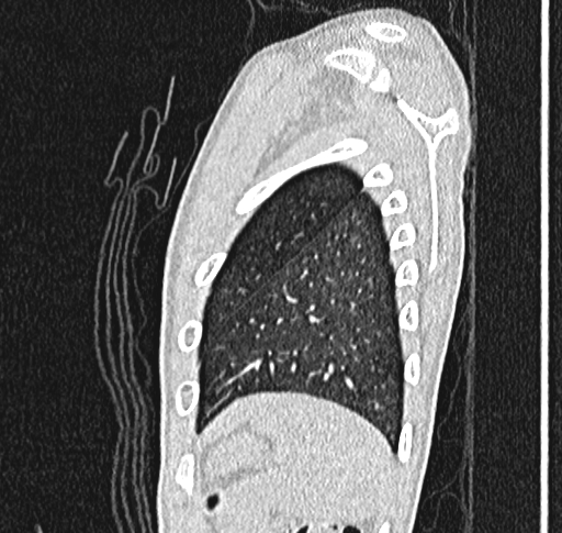 File:Bronchiolitis obliterans (Radiopaedia 71538-81897 Sagittal lung window 63).jpg