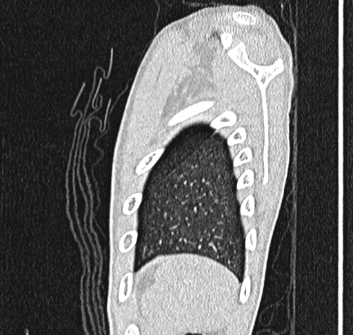 Bronchiolitis obliterans (Radiopaedia 71538-81897 Sagittal lung window 65).jpg