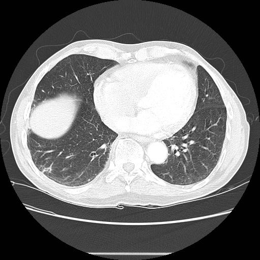 Bronchocele (Radiopaedia 17097-16795 Axial lung window 82).jpg