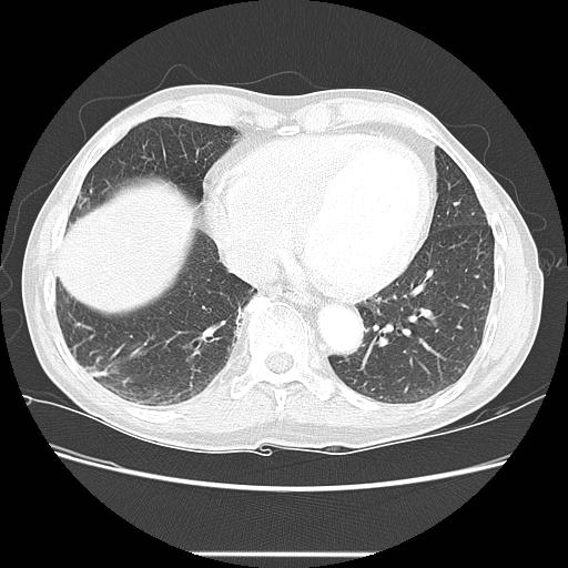 Bronchocele (Radiopaedia 17097-16795 Axial lung window 85).jpg