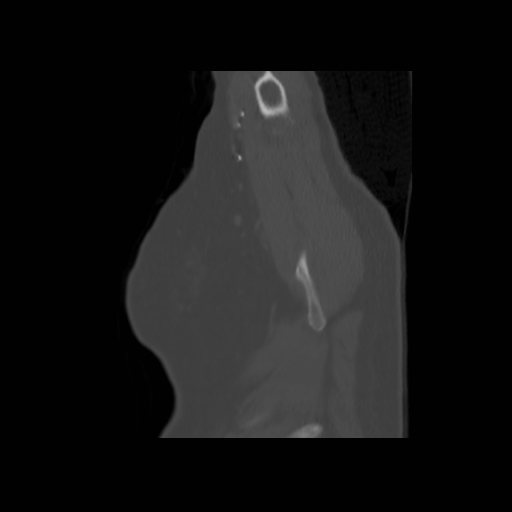 Bronchogenic carcinoma (Radiopaedia 73497-84262 Sagittal bone window 17).jpg