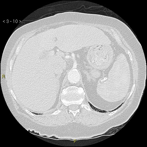 Bronchogenic carcinoma as an incidental finding (Radiopaedia 16453-16130 Axial lung window 10).jpg