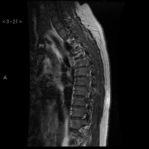 File:Bronchogenic cyst - posterior mediastinal (Radiopaedia 43885-47365 Sagittal T1 21).jpg