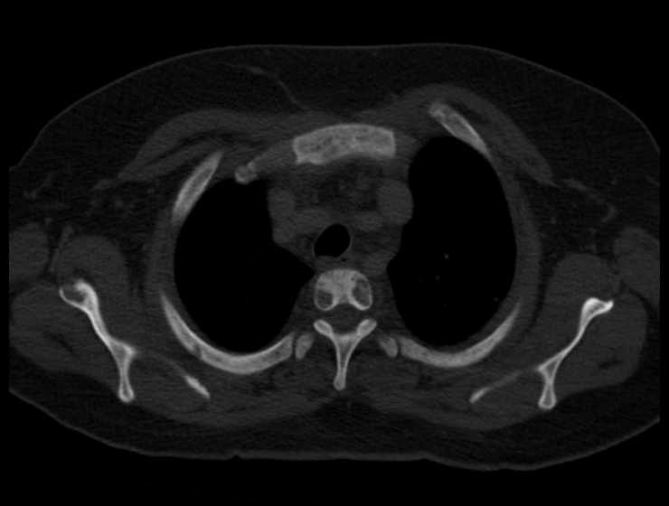 File:Brown tumors compressing the spinal cord (Radiopaedia 68442-77988 Axial bone window 14).jpg