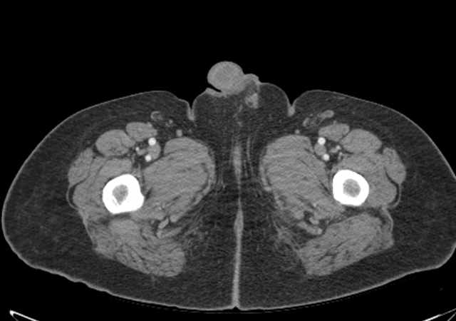Brown tumors compressing the spinal cord (Radiopaedia 68442-77988 E 144).jpg