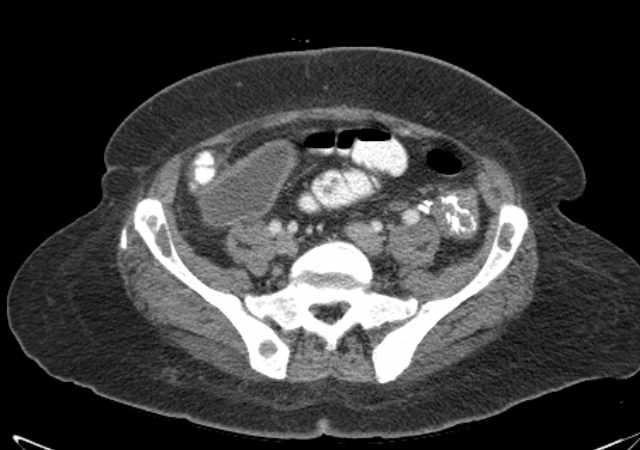 Brown tumors compressing the spinal cord (Radiopaedia 68442-77988 E 91).jpg