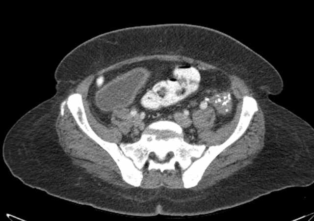 Brown tumors compressing the spinal cord (Radiopaedia 68442-77988 E 93).jpg