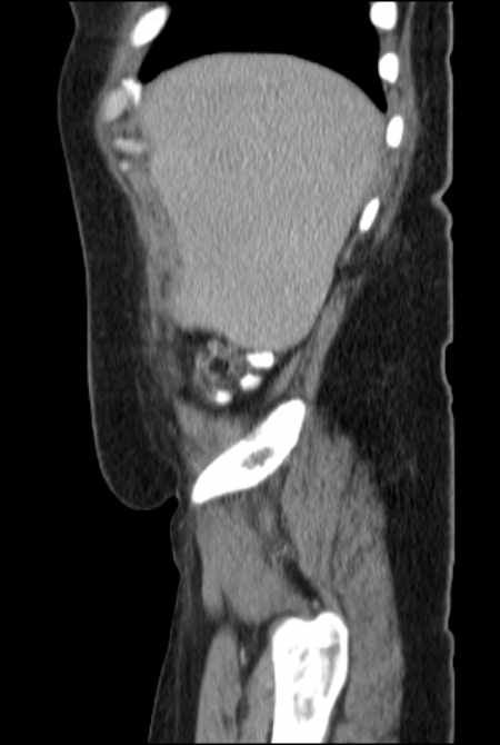 Brown tumors compressing the spinal cord (Radiopaedia 68442-77988 F 10).jpg